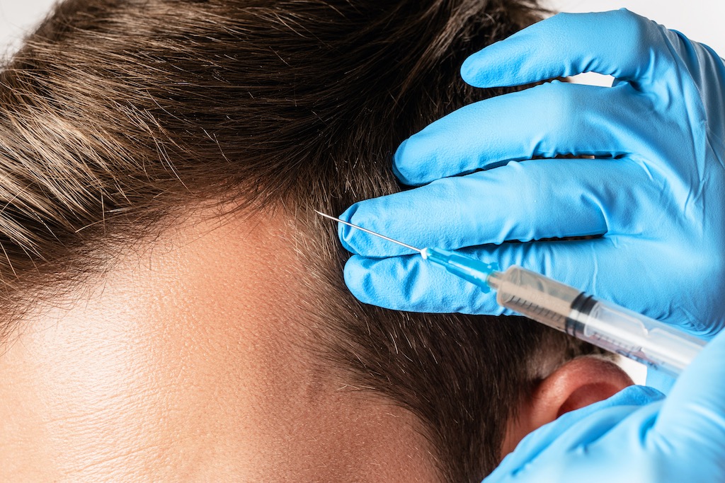 prp, hair loss