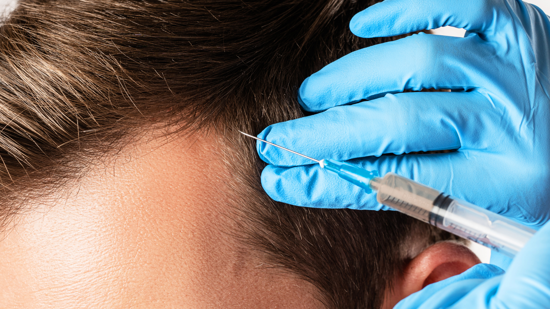 Is PRP for Hair Restoration Safe and Effective? - LT Men's Clinic
