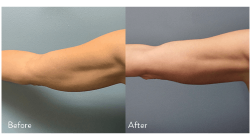 contouring, arms contouring, wellness and beauty