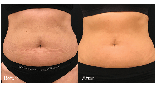 contouring, belly contouring, wellness and beauty