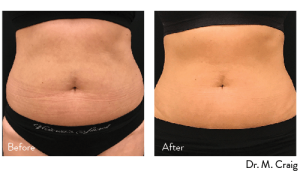 contouring, stomach contouring, wellness and beauty