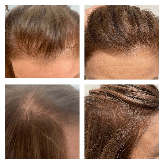 PRP for women, hair restoration, Before pictures