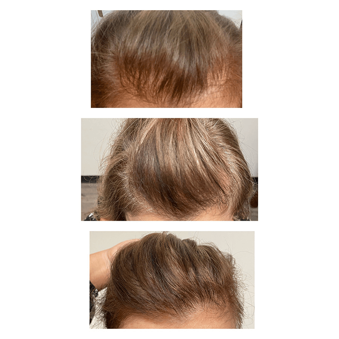 PRP for women, hair restoration
