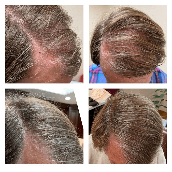 PRP, Baldness, Hair restoration