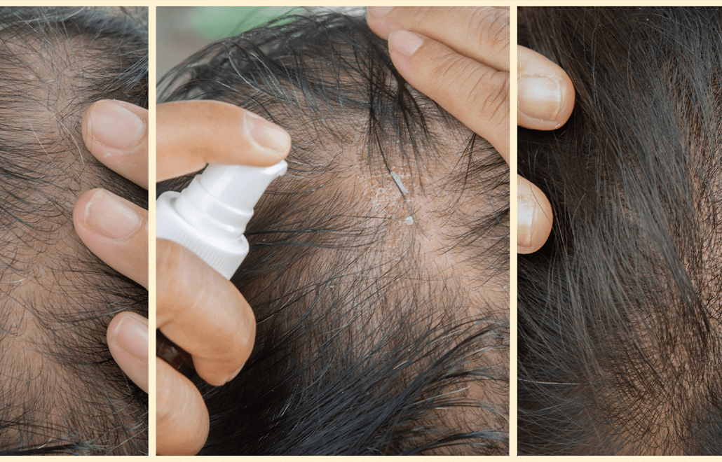 Hair growth, hair loss, PRP therapy, thicker hair